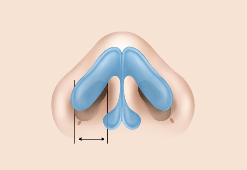 Inner Incision