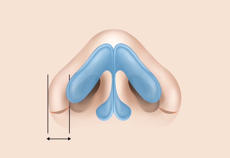 Outer Incision