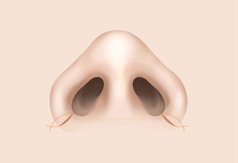Alar Incision