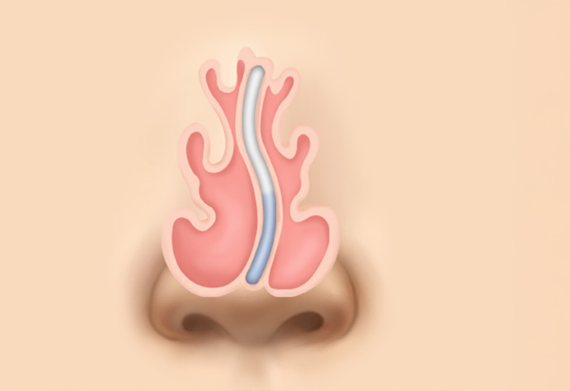 Deviated Septum Correction