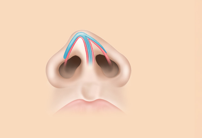 Nasal Valve Reconstruction