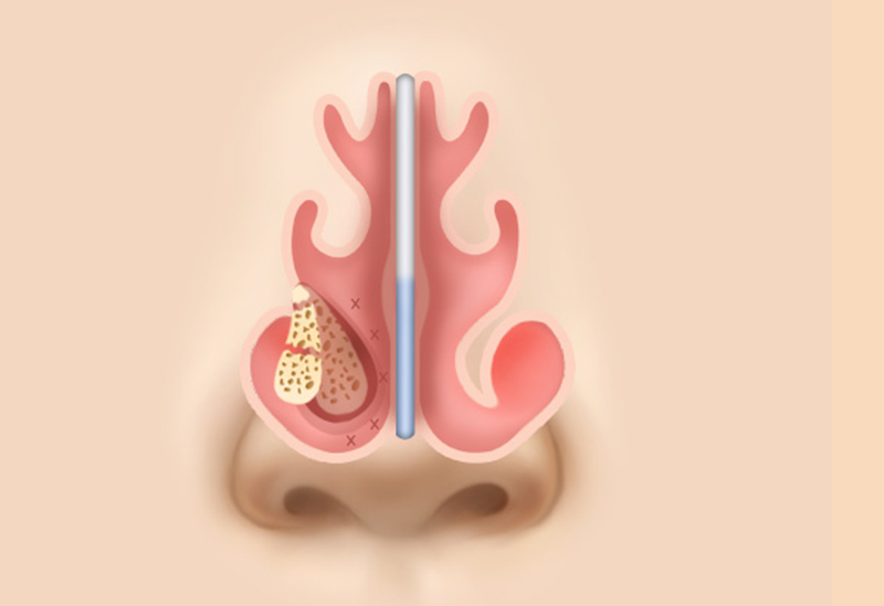 Chronic / Hypertrophic Rhinitis