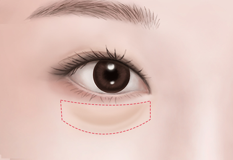 Conjunctival Incision and Fat Removal