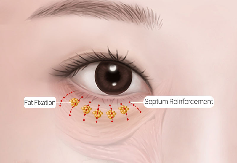 Suturing and Recovery